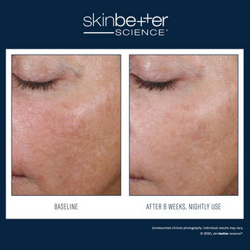 Even Tone Correcting Serum - Hyperpigmentation - SkinBetter Science